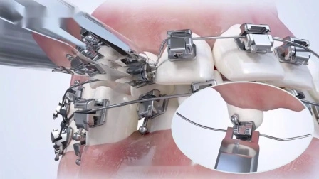 Orthodontic Products는 수동형 자가결찰 교정장치를 제조합니다.